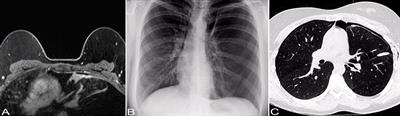 Case report: Pulmonary synovial sarcoma in a long-term survivor of childhood Hodgkin lymphoma
